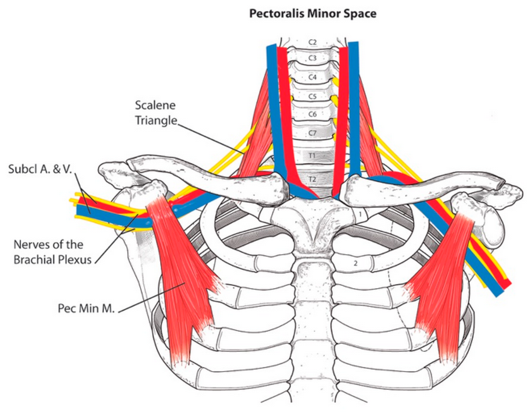 Syndrome de tunnel scalène et pect mineur